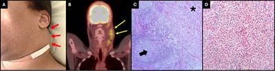 Overlap of membranous nephropathy and IgA nephropathy in a patient with Kimura’s disease: a case report and literature review